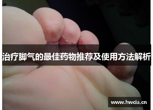 治疗脚气的最佳药物推荐及使用方法解析